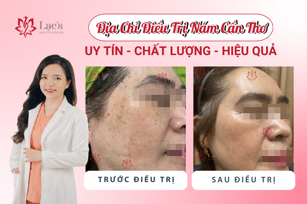 Cùng Lạc’s Beauty Center khám phá địa trị điều trị nám Cần Thơ hiệu quả!