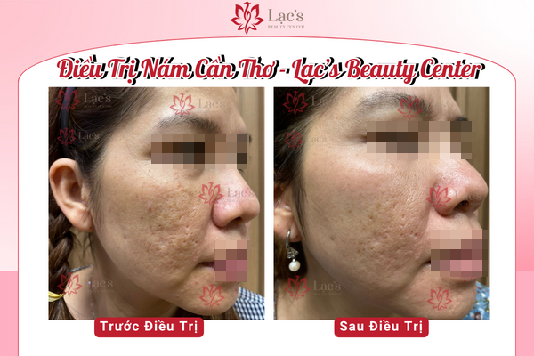 Hình ảnh điều trị thành công ca nám nặng cho khách nữ tại Lạc’s Beauty Center