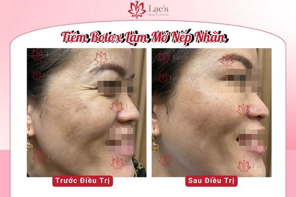 Hình ảnh Khách chọn Tiêm Botox Làm Mờ Nếp Nhăn hiệu quả tại Lạc’s Beauty Center