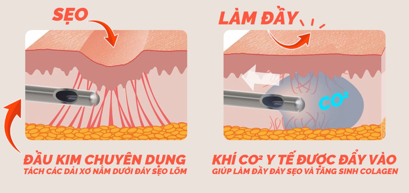 BÓC TÁCH SẸO BẰNG KHÍ CO2