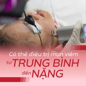 Laser FlexSys điều trị mụn viêm trung bình đến nặng