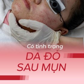 Laser FlexSys điều trị tình trạng đỏ da sau mụn