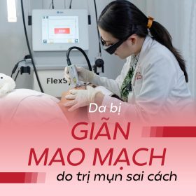 Laser FlexSys giúp điều trị giãn mao mạch do điều trị mụn sử dụng corticoid